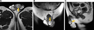 Case report and literature review: Primary leiomyosarcoma of the penis